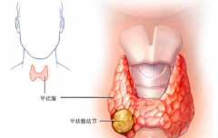 甲状腺结节的相关问题?