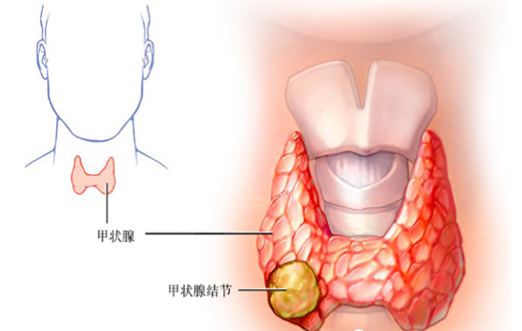 重庆甲状腺医院